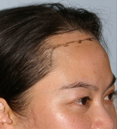 Asian Forehead Reduction - Patient 5 - Obl Right - Before