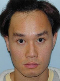 Asian Forehead Reduction - Patient 6 - Front - Before