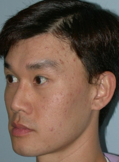 Asian Forehead Reduction - Patient 6 - Obl Left - After