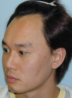Asian Forehead Reduction - Patient 6 - Obl Left - Before Asian Forehead Reduction - Patient 6 - Obl Left - Before