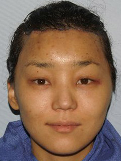 Asian Forehead Reduction - Patient 1 - Front - After