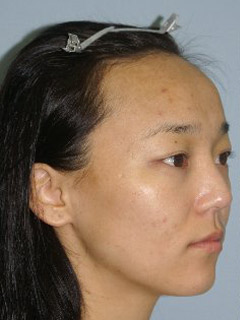 Asian Forehead Reduction - Patient 1 - Obl Right - Before Asian Forehead Reduction - Patient 1 - Obl Right - Before