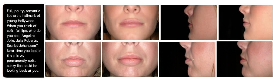 Perma Facial Implants for Lips in OAK, CA