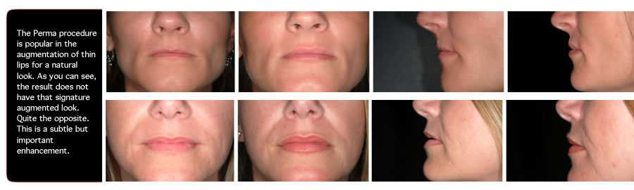 Perma Facial Implants for Lips in OAK