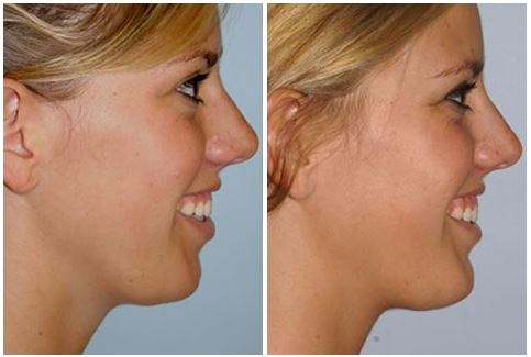 Chin Augmentation in Oakland