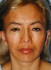 Skin Rejuvenation Techniques in Oakland Skin Rejuvenation Techniques in Oakland