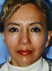 Skin Rejuvenation Techniques in Oakland, CA Skin Rejuvenation Techniques in Oakland, CA