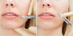 How Recent Advancements Have Improved Filler Injection Treatments