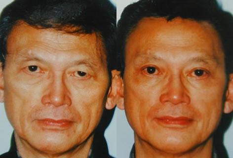 Asian Eyelid before and after photos in San Francisco, CA, Patient 12891