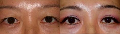 Asian Eyelid before and after photos in San Francisco, CA, Patient 12894