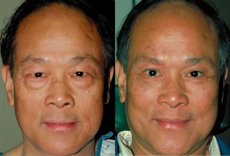 Asian Eyelid before and after photos in San Francisco, CA, Patient 12897