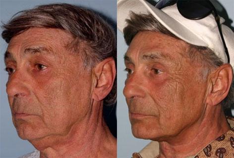 Direct Excision Of Neck Skin before and after photos in San Francisco, CA, Patient 13193