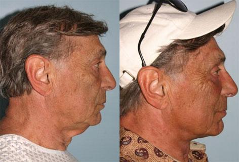 Direct Excision Of Neck Skin before and after photos in San Francisco, CA, Patient 13193