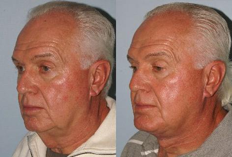 Direct Excision Of Neck Skin before and after photos in San Francisco, CA, Patient 13201