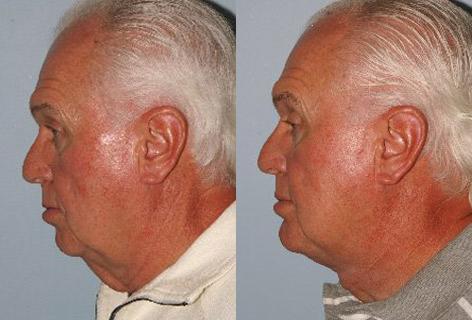 Direct Excision Of Neck Skin before and after photos in San Francisco, CA, Patient 13201