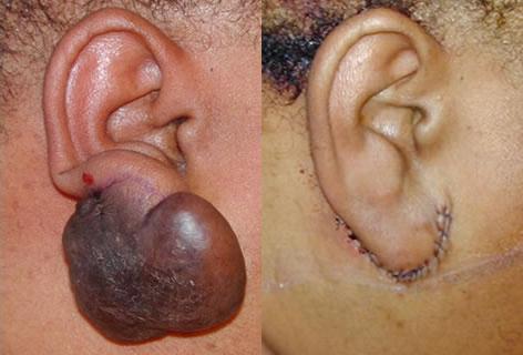 Keloid Removal before and after photos in San Francisco, CA, Patient 13253