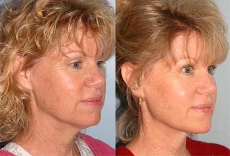 Neck Lift before and after photos in San Francisco, CA, Patient 13287