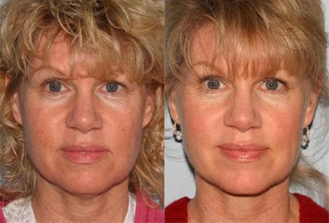 Neck Lift before and after photos in San Francisco, CA, Patient 13287