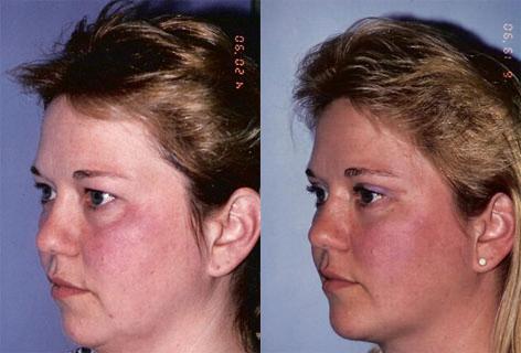 Neck Lift before and after photos in San Francisco, CA, Patient 13294