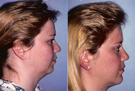 Neck Lift before and after photos in San Francisco, CA, Patient 13294