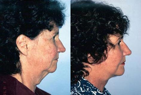 Neck Lift before and after photos in San Francisco, CA, Patient 13299