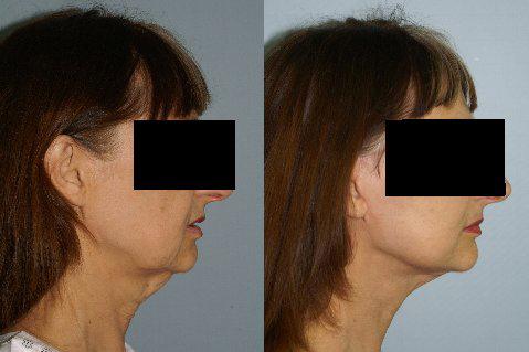 Neck Lift before and after photos in San Francisco, CA, Patient 13304