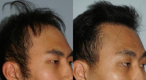 Follicular Unit Hair Grafting before and after photos in San Francisco, CA, Patient 13539