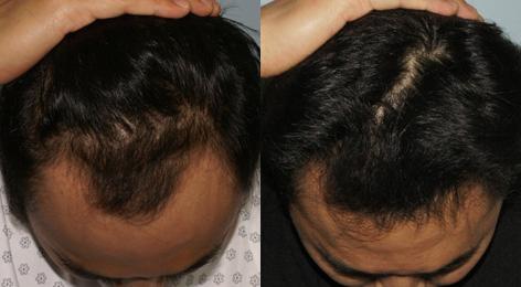 Follicular Unit Hair Grafting before and after photos in San Francisco, CA, Patient 13539