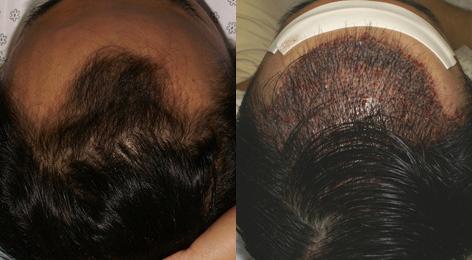 Patient 13539, Follicular Unit Hair Grafting before and after photos Follicular Unit Hair Grafting before and after photos in San Francisco, CA, Patient 13539