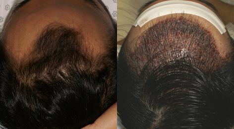 Follicular Unit Hair Grafting before and after photos in San Francisco, CA, Patient 13539