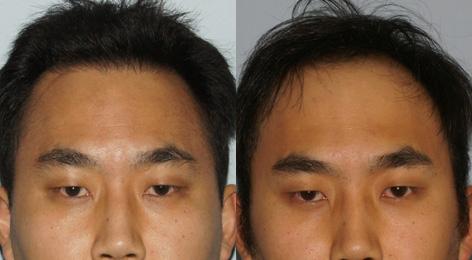 Follicular Unit Hair Grafting before and after photos in San Francisco, CA, Patient 13539