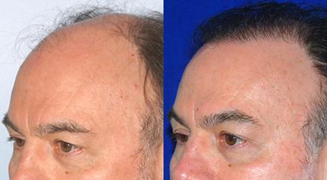 Follicular Unit Hair Grafting before and after photos in San Francisco, CA, Patient 13548