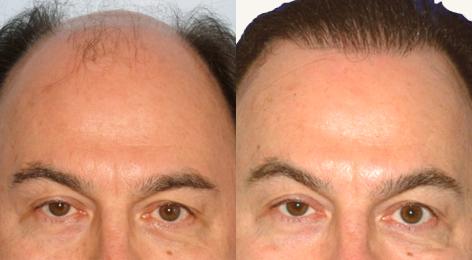 Follicular Unit Hair Grafting before and after photos in San Francisco, CA, Patient 13548