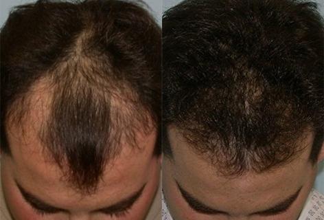 Follicular Unit Hair Grafting before and after photos in San Francisco, CA, Patient 13549
