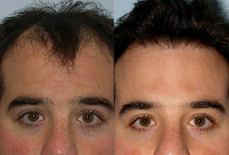 Follicular Unit Hair Grafting before and after photos in San Francisco, CA, Patient 13549