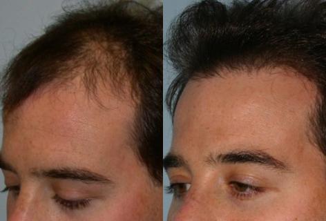 Follicular Unit Hair Grafting before and after photos in San Francisco, CA, Patient 13549