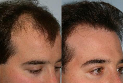Follicular Unit Hair Grafting before and after photos in San Francisco, CA, Patient 13549