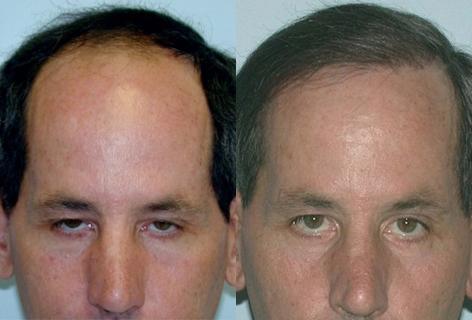 Follicular Unit Hair Grafting before and after photos in San Francisco, CA, Patient 13552