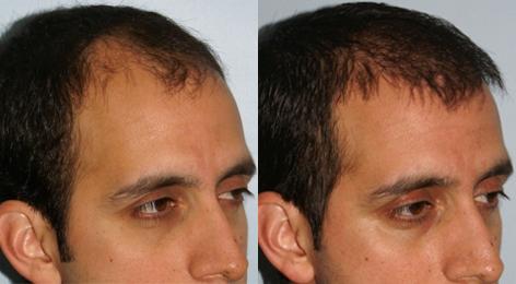 Follicular Unit Hair Grafting before and after photos in San Francisco, CA, Patient 13553