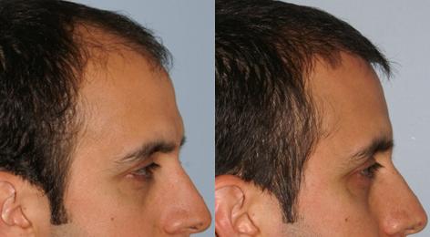 Follicular Unit Hair Grafting before and after photos in San Francisco, CA, Patient 13553