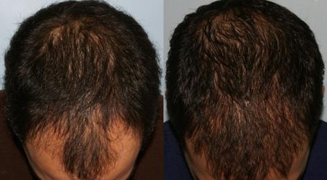 Follicular Unit Hair Grafting before and after photos in San Francisco, CA, Patient 13553