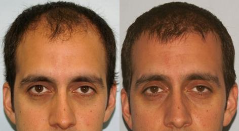 Follicular Unit Hair Grafting before and after photos in San Francisco, CA, Patient 13553