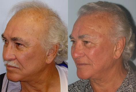 Follicular Unit Hair Grafting before and after photos in San Francisco, CA, Patient 13554