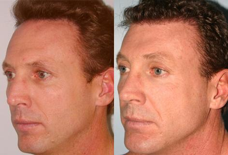 Follicular Unit Hair Grafting before and after photos in San Francisco, CA, Patient 13559