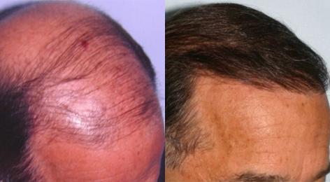 Follicular Unit Hair Grafting before and after photos in San Francisco, CA, Patient 13562