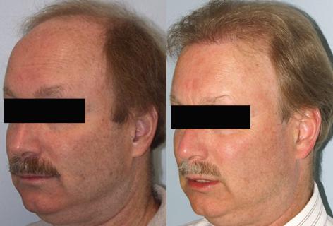 Follicular Unit Hair Grafting before and after photos in San Francisco, CA, Patient 13565