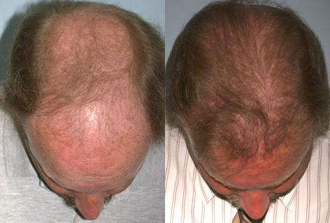 Follicular Unit Hair Grafting before and after photos in San Francisco, CA, Patient 13565