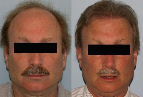 Follicular Unit Hair Grafting before and after photos in San Francisco, CA, Patient 13565