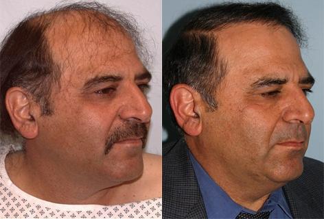Follicular Unit Hair Grafting before and after photos in San Francisco, CA, Patient 13572