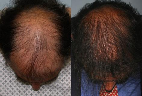 Follicular Unit Hair Grafting before and after photos in San Francisco, CA, Patient 13572